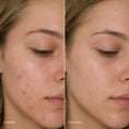 Bild in Galerie-Betrachter laden, MedandSkin Blemish Control Routine | Akne
